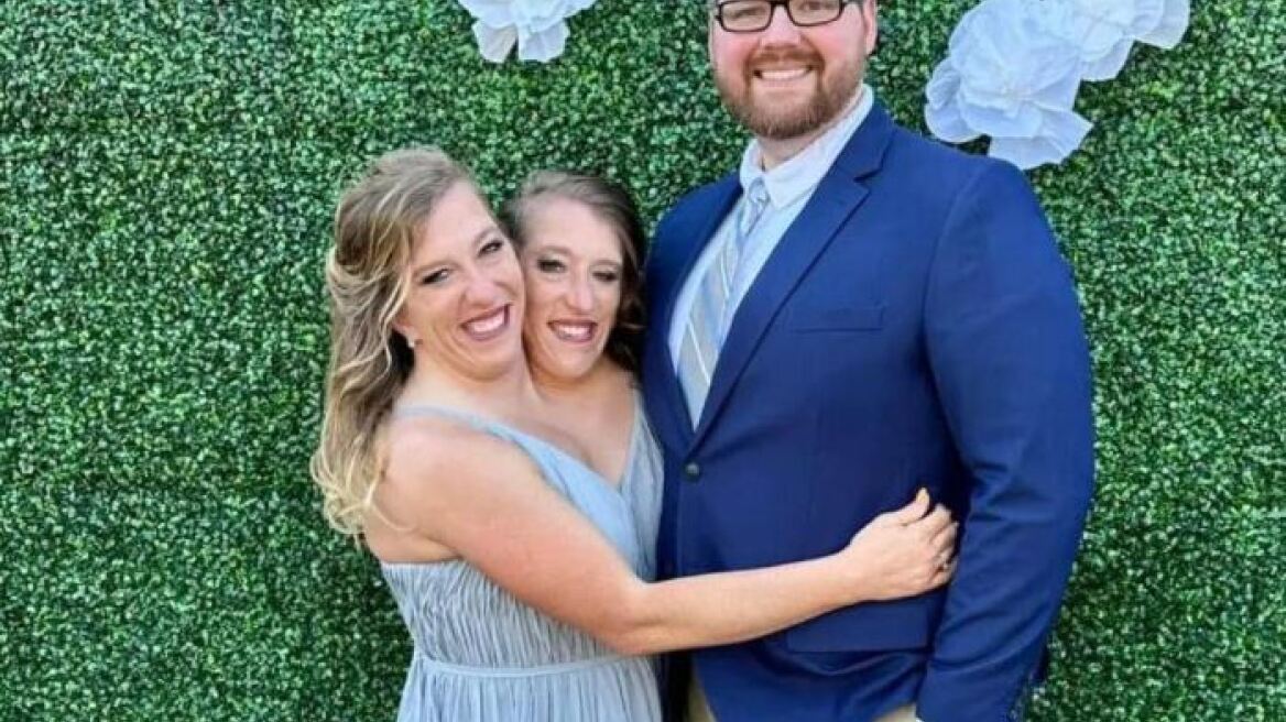 Παντρεύτηκε σιαμαία που μοιράζεται το ίδιο σώμα με τη δίδυμη αδερφή της