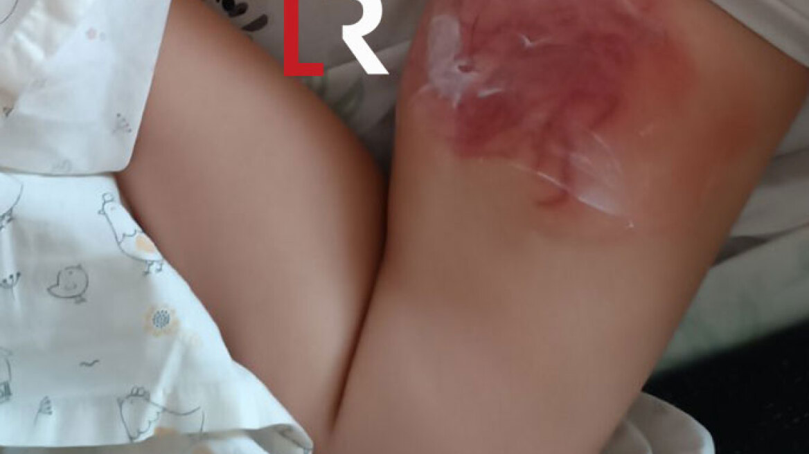 Φθιώτιδα: Σοβαρά εγκαύματα σε 4χρονη από θαλάσσια ανεμώνη