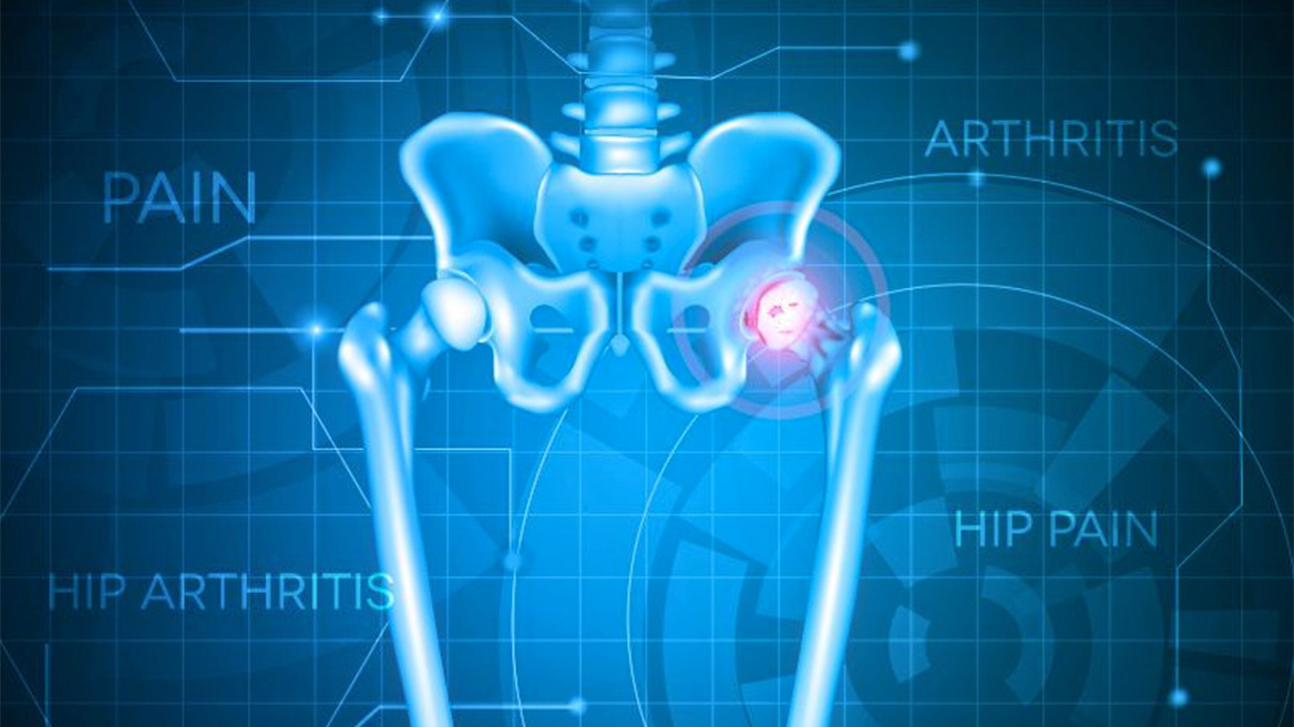 Εξελίξεις στην ολική αρθροπλαστική ισχίου