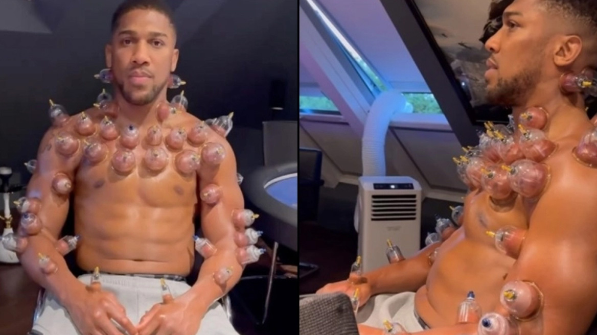 Ο πυγμάχος Άντονι Τζόσουα κάνει θεραπεία με «βεντούζες» (vid)