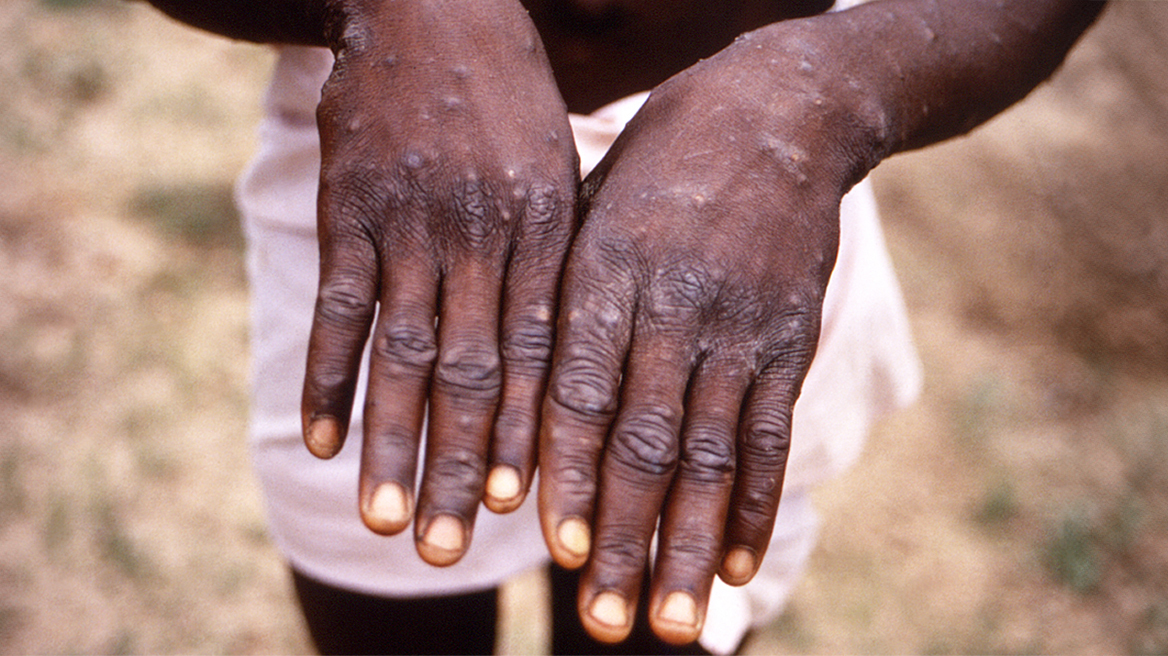 Πρώτος θάνατος στη Γκάνα εξαιτίας της επιδημίας mpox 