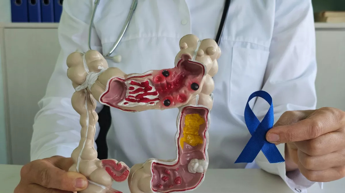 Καρκίνος παχέος εντέρου: 67.000 πολίτες παρέλαβαν το self-test – Πόσα είναι τα θετικά δείγματα