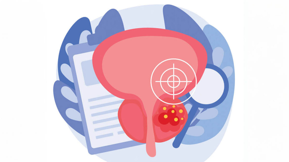 Αιματουρία και καρκίνος ουροδόχου κύστης