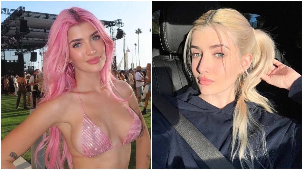 Η 21χρονη κόρη του Τσάρλι Σιν αποκάλυψε όλες τις πλαστικές επεμβάσεις που έχει κάνει: Fillers, ρινοπλαστική και αυξητική στήθους