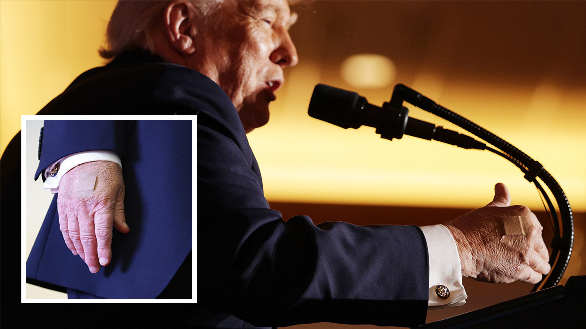 Τα τσιρότα στα χέρια του Τραμπ πυροδοτούν και πάλι φήμες για την υγεία του: Κάνει συνέχεια χειραψίες, λέει ο Λευκός Οίκος