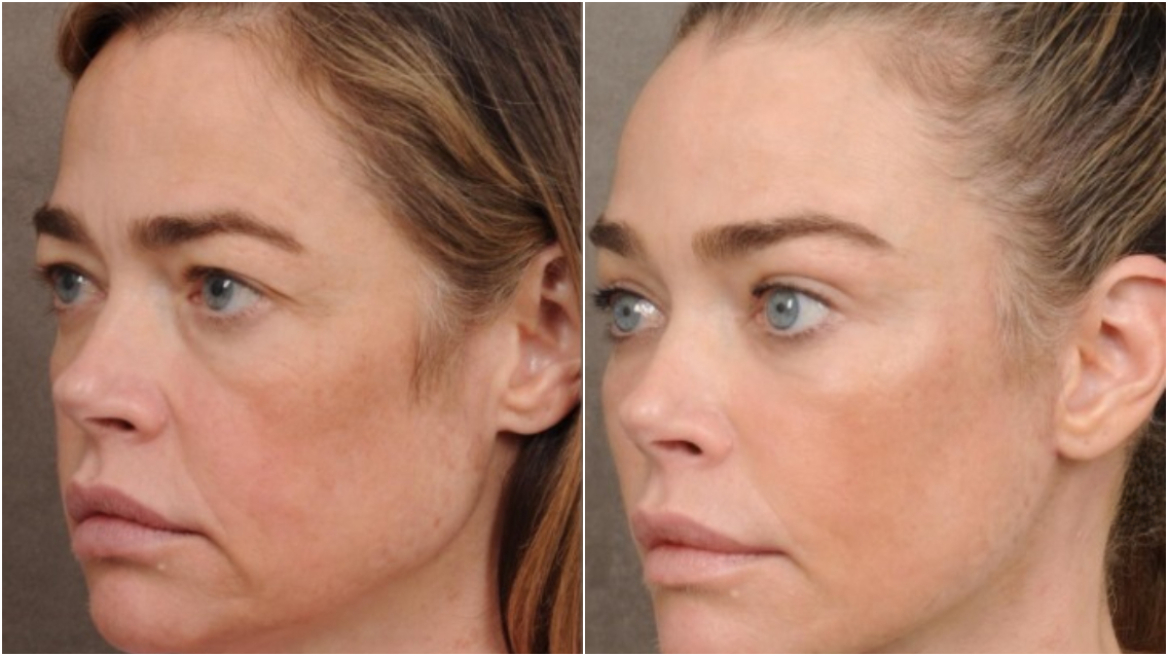 Ντενίζ Ρίτσαρντς: Φωτογραφίες με το πρόσωπό της πριν και μετά το λίφτινγκ