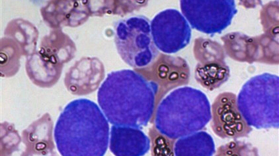 Βρέθηκε το φάρμακο για την φαλάκρα;