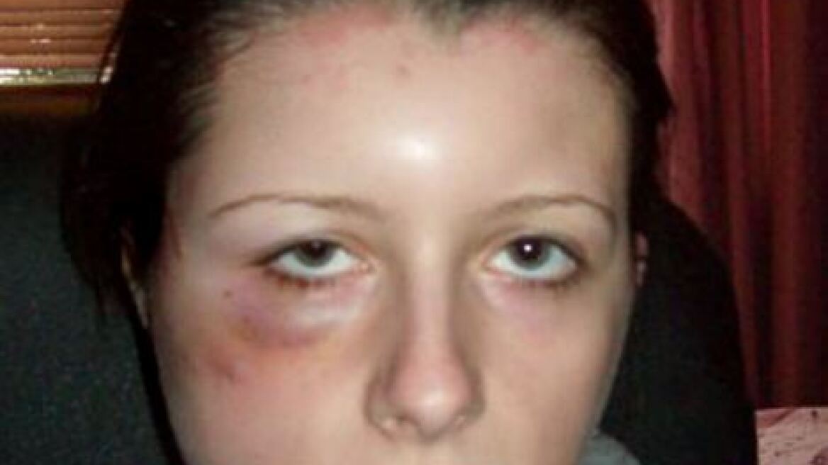 Παραλίγο να πεθάνει από βαφή μαλλιών