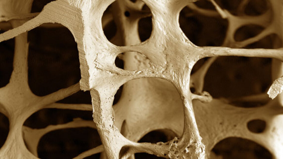Κίνδυνος εμφάνισης καρκίνου από φάρμακα κατά της οστεοπόρωσης