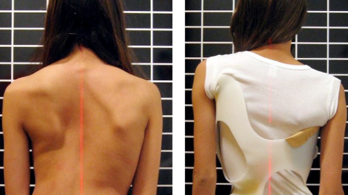 Μάθετε πώς αντιμετωπίζεται η Ιδιοπαθής Εφηβική Σκολίωση