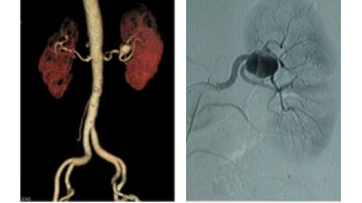 Dr. Νίκος Παρασκευάς: Aνευρύσματα των σπλαχνικών αρτηριών