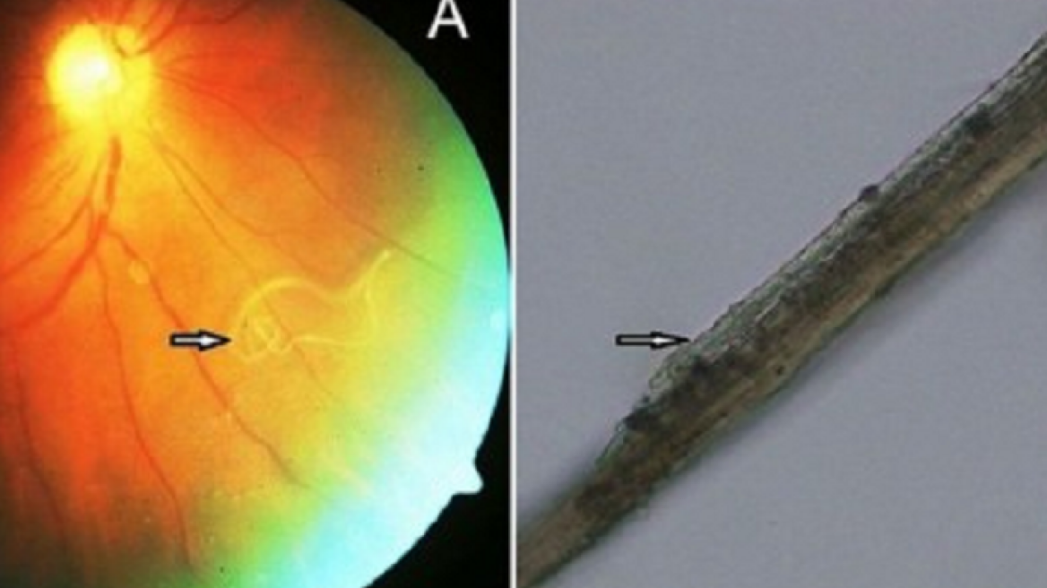 Baffled doctors find a worm living and growing in a man's eye