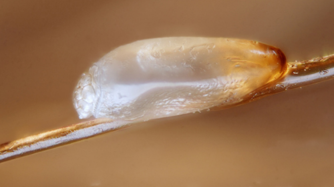 Βρετανία: Ψείρες ανθεκτικές στα ειδικά σαμπουάν