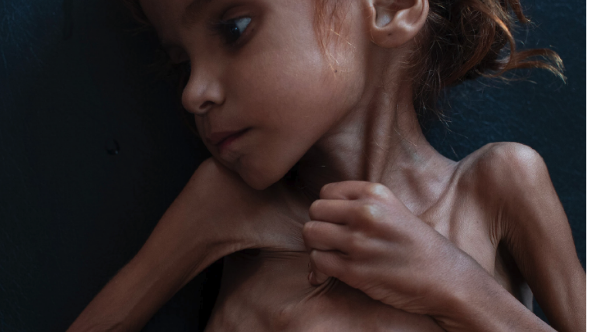 Το Facebook της λογοκρισίας: Διέγραψε τη συγκλονιστική φωτογραφία της 7χρονης στην Υεμένη που «σβήνει» από την πείνα