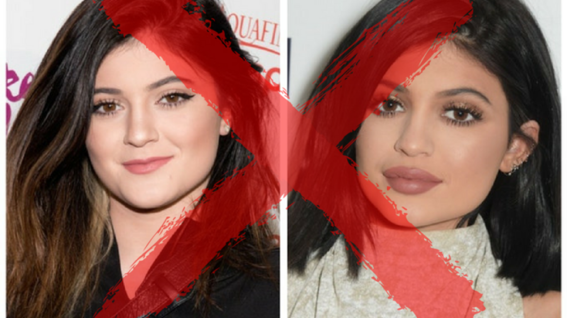 Όχι άλλα lip fillers!