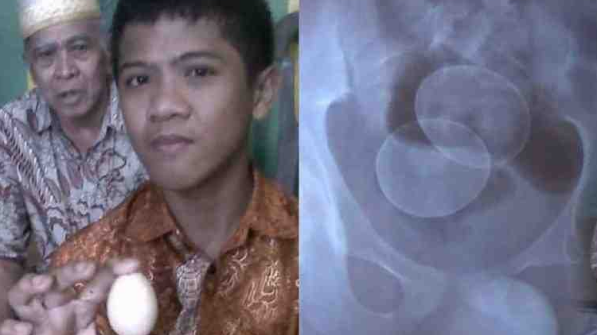 Οι επιστήμονες τρελάθηκαν: 14χρονος «γεννά» αυγά στην Ινδονησία