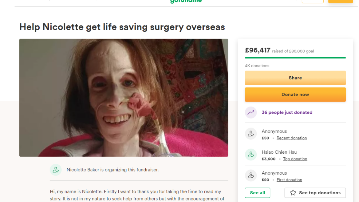 Βρετανία: 36χρονη με σπάνιο σύνδρομο στομάχου ζυγίζει κάτω από 20 κιλά - Διαγνώστηκε λανθασμένα με νευρική ανορεξία