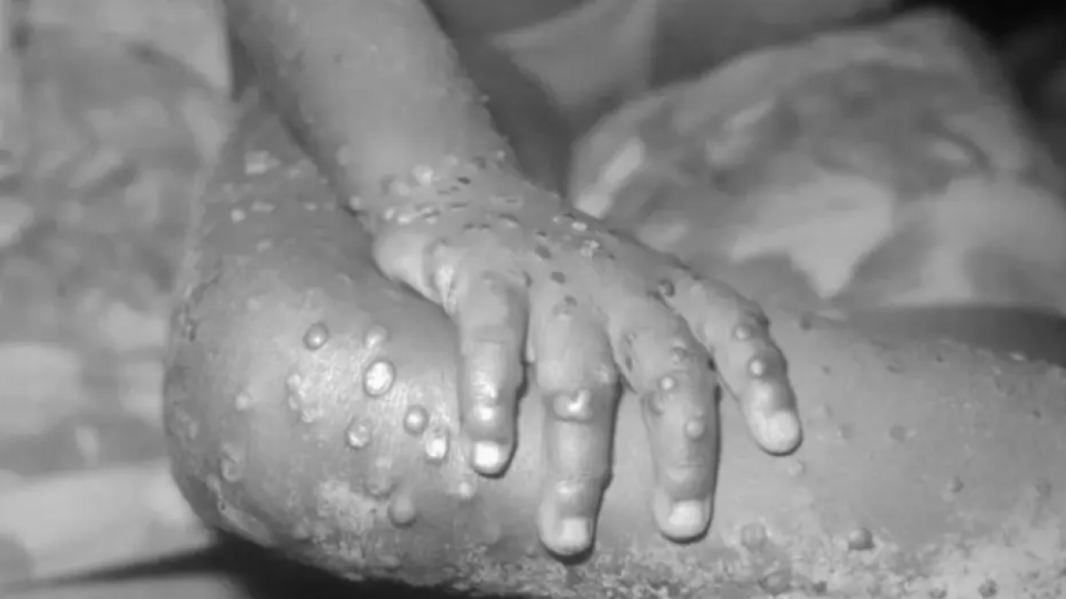 Ευλογιά των πιθήκων: Τα πρώτα κρούσματα κατέγραψαν Ουγγαρία και Νορβηγία 