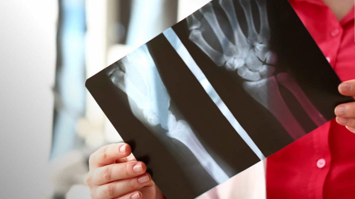 Οστά και μέταλλα: Σχέση αλληλοϋποστήριξης