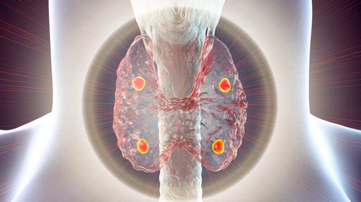 Υπερπαραθυρεοειδισμός: Πώς επηρεάζει την υγεία μας;