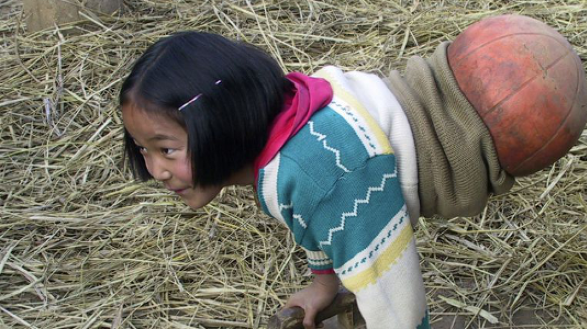 Κίνα: Η 4χρονη που έχασε τα πόδια της και ζούσε πάνω σε μια μπάλα...