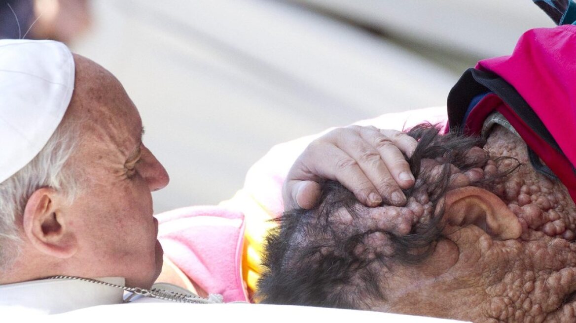 Δείτε φωτογραφίες: Το φιλί του Πάπα σε έναν παραμορφωμένο