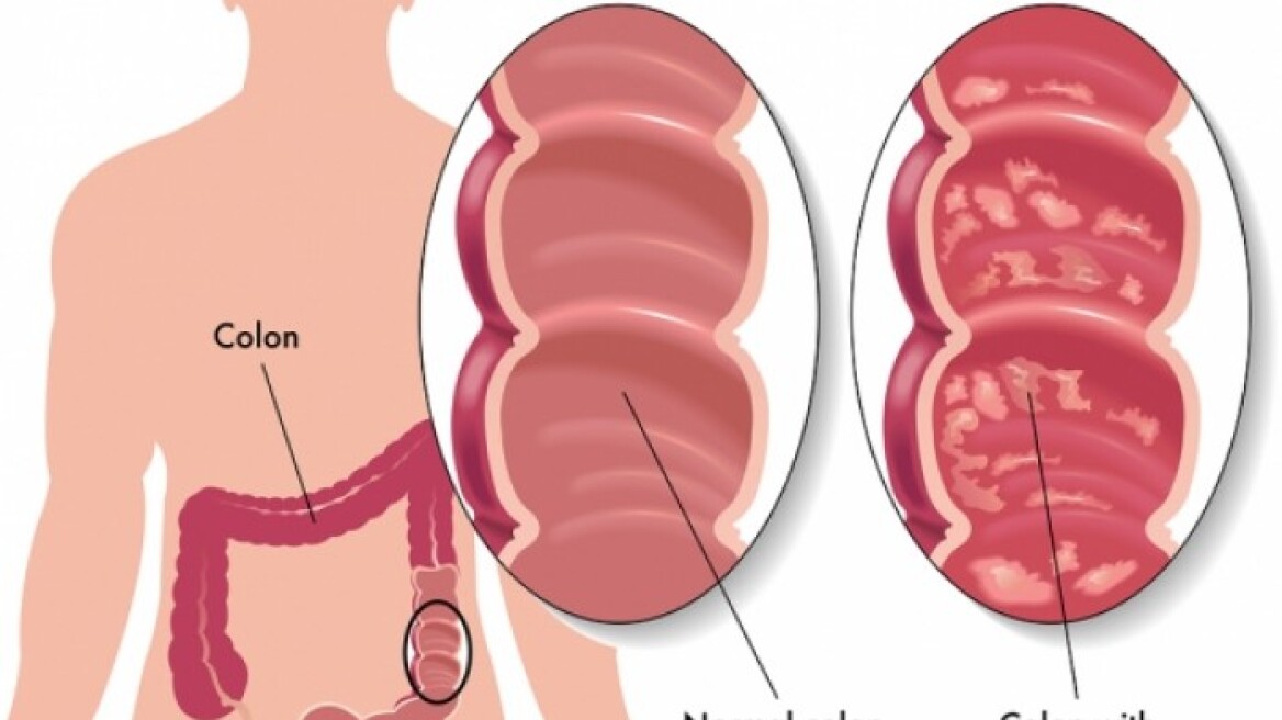 Η νόσος Crohn και η ελκώδης κολίτιδα δεν είναι ταμπού 