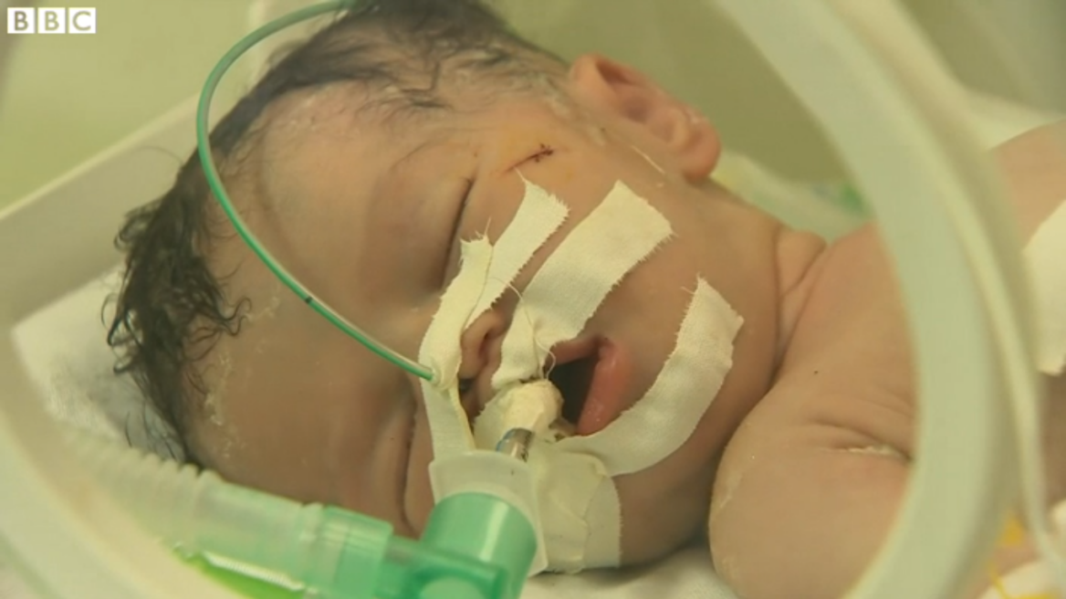 Γάζα: Γιατροί έσωσαν βρέφος κάνοντας καισαρική στη νεκρή μητέρα του