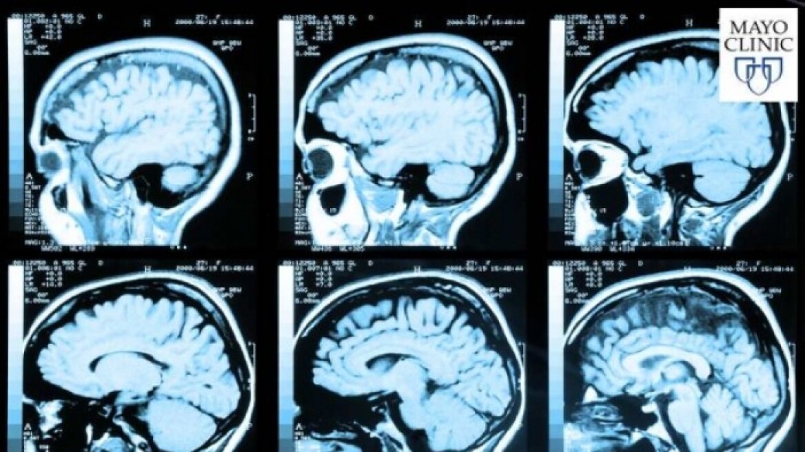 Ανεύρυσμα στον εγκέφαλο: Ποια είναι τα συμπτώματα; 