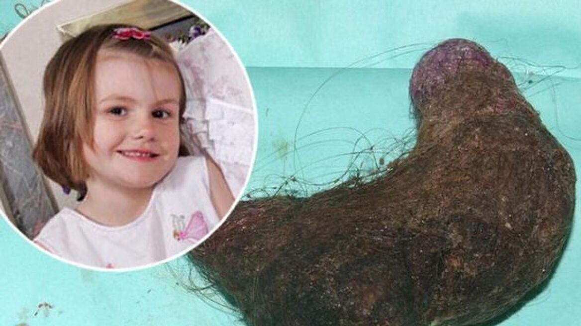 Μία 5χρονη κόντεψε να πεθάνει επειδή έτρωγε τα μαλλιά της!