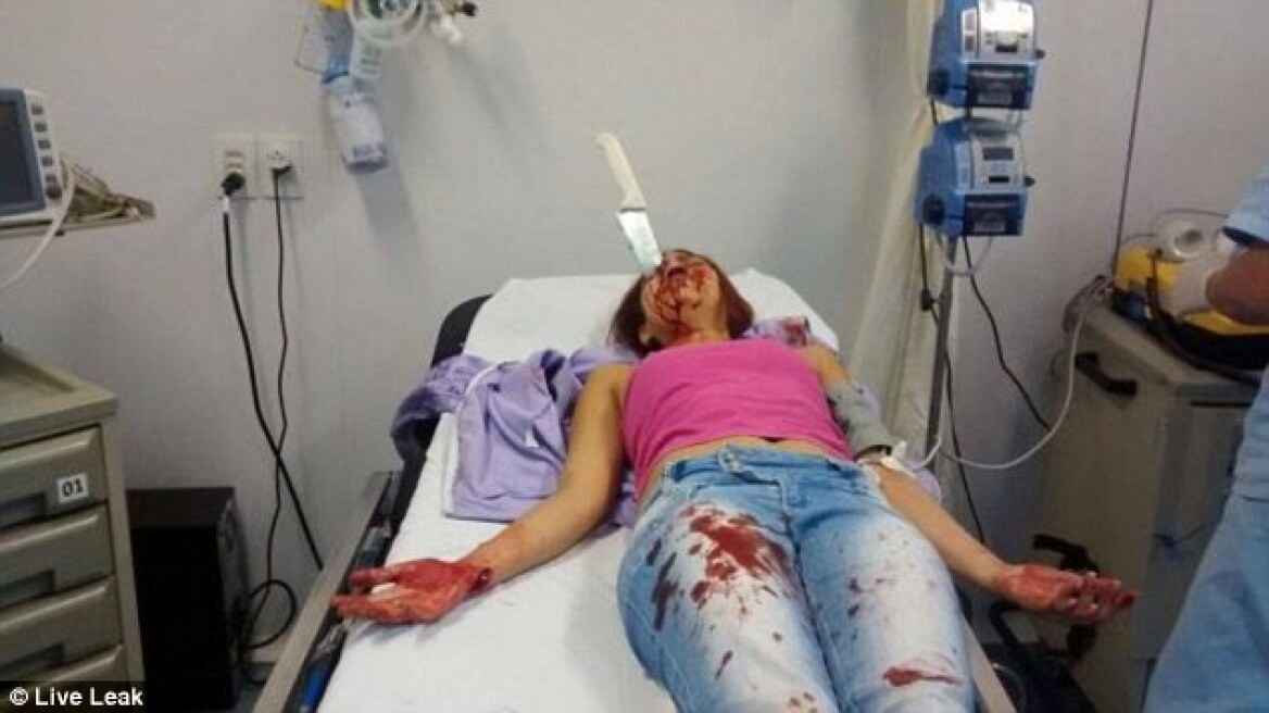 Βραζιλία: Γυναίκα επέζησε με καρφωμένο μαχαίρι στο κεφάλι 