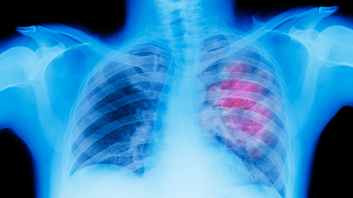 Ο καρκίνος του πνεύμονα μπορεί να παραμείνει κρυμμένος για πάνω από 20 χρόνια
