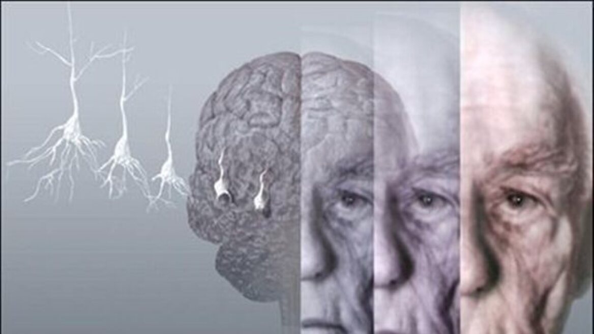 Πόσο κοντά είναι η σχιζοφρένεια με τη νόσο Αλτσχάιμερ;
