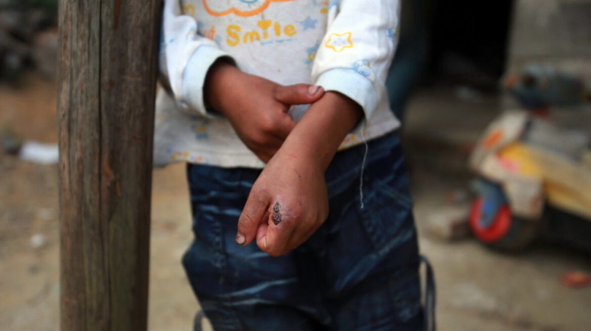 Κίνα: Χωρικοί εκδιώχνουν ένα 8χρονο αγόρι που έχει μολυνθεί από τον ιό HIV