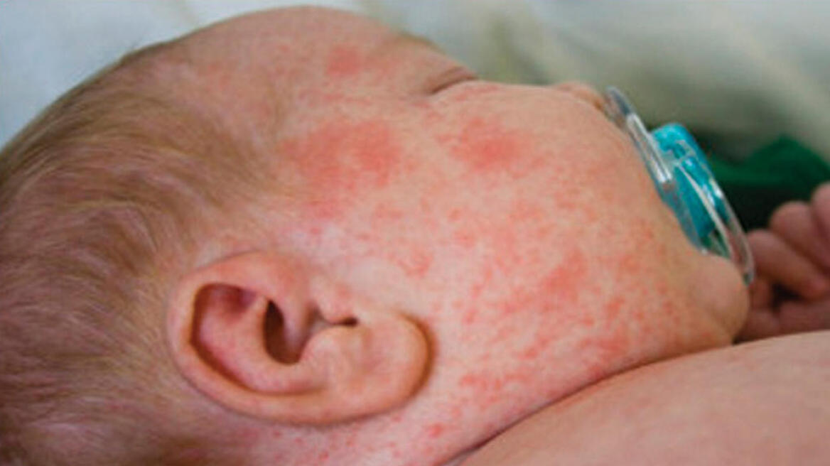 Βερολίνο: Μωρό πέθανε από την επιδημία ιλαράς