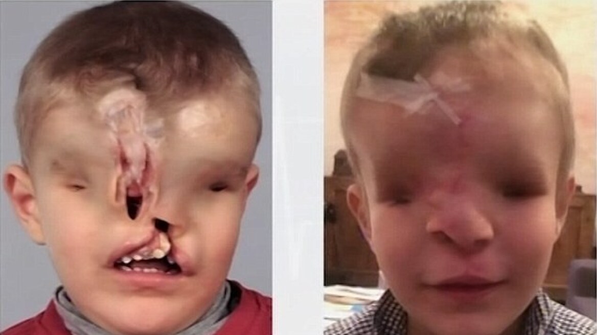 Αυστραλία: Ο 3χρονος Γιάχια υποβλήθηκε σε χειρουργείο για να αποκτήσει μύτη και μάτια!