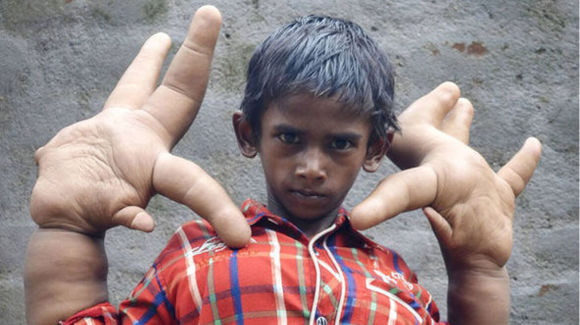 Ινδία: Η ιστορία του αγοριού με τα μεγαλύτερα χέρια στον κόσμο