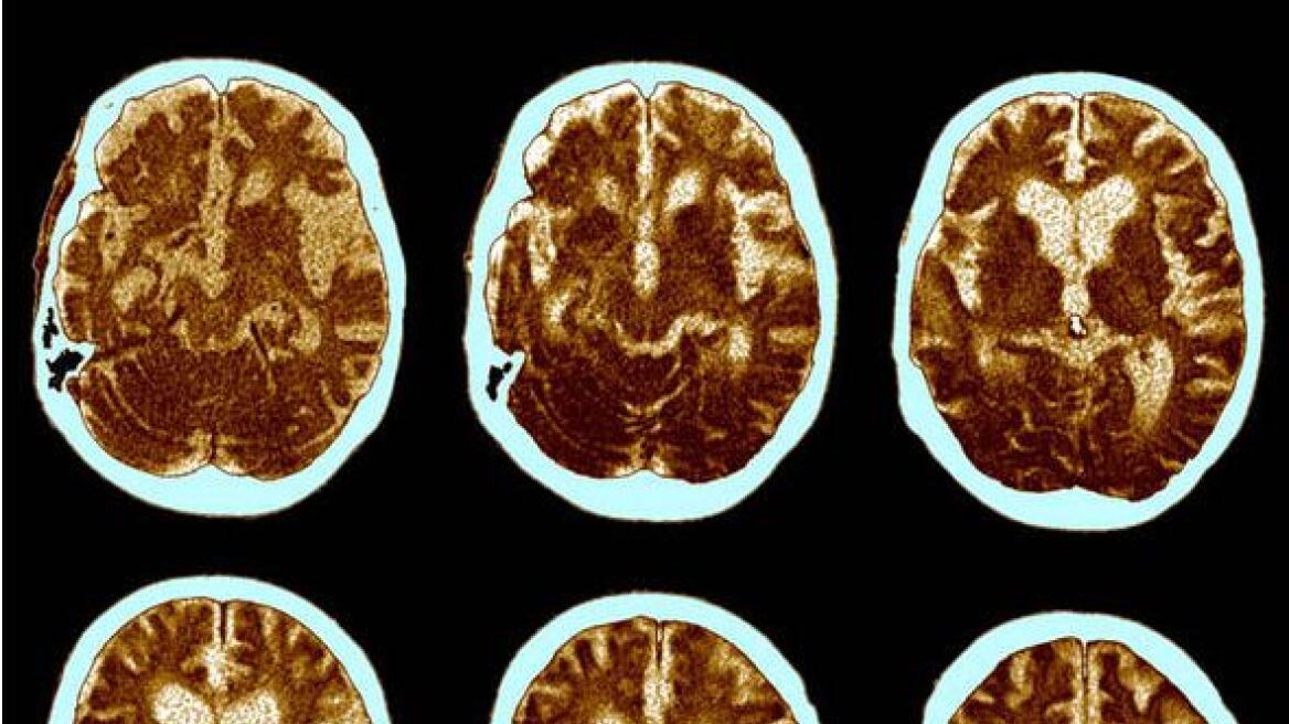 Μία νέα ανακάλυψη βάζει «φρένο» στην πορεία της νόσου Αλτσχάιμερ