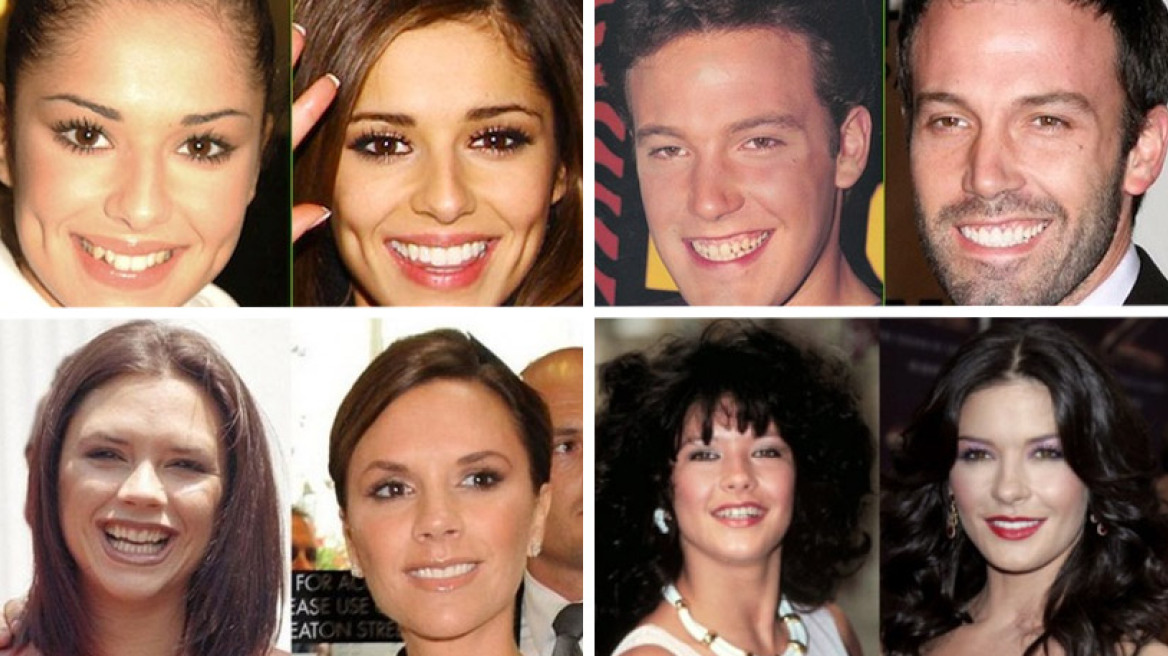 Φωτογραφίες πριν και μετά: Οι celebrities που έφτιαξαν τα δόντια τους