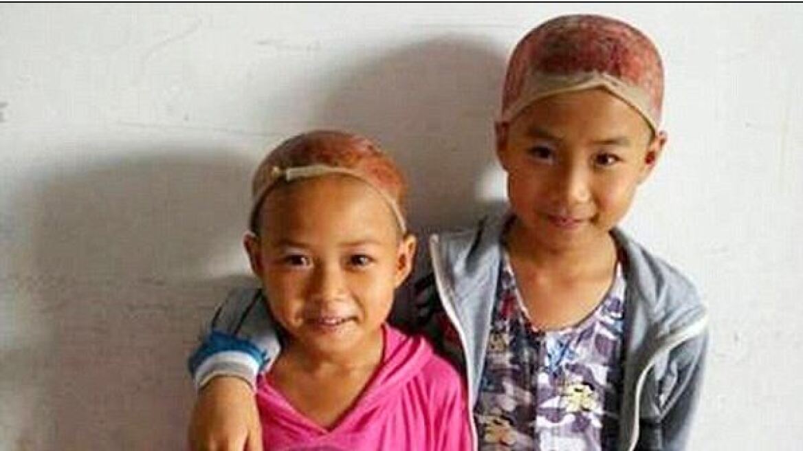 Κίνα: Αδερφάκια δωρίζουν δέρμα του κεφαλιού τους στον πατέρα τους που υπέστη έγκαυμα