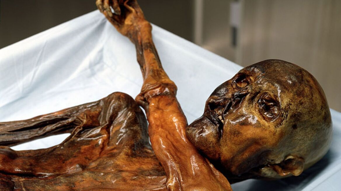 Ότζι: Ο ηλικίας 5.300 ετών «Παγωμένος Άνθρωπος» είχε... έλκος!