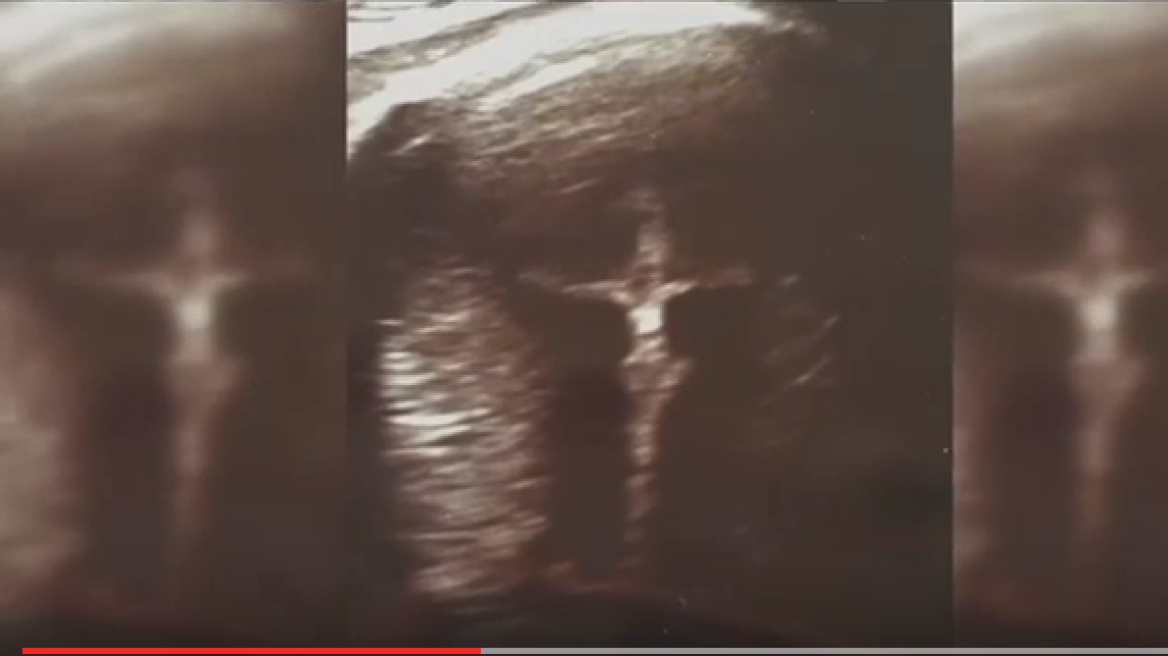 Jesus ‘appears’ in woman’s prenatal sonogram! (video)