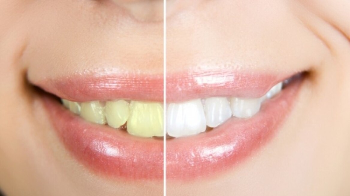 Λευκά δόντια: Με ποιους τρόπους τα αποκτάτε