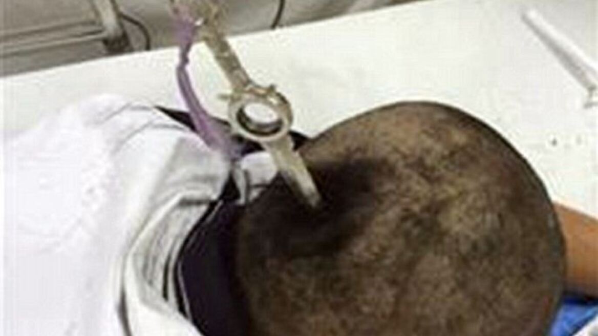 Θρίλερ στην Κίνα: Μεταφέρθηκε με στιλέτο καρφωμένο στο κεφάλι και επέζησε