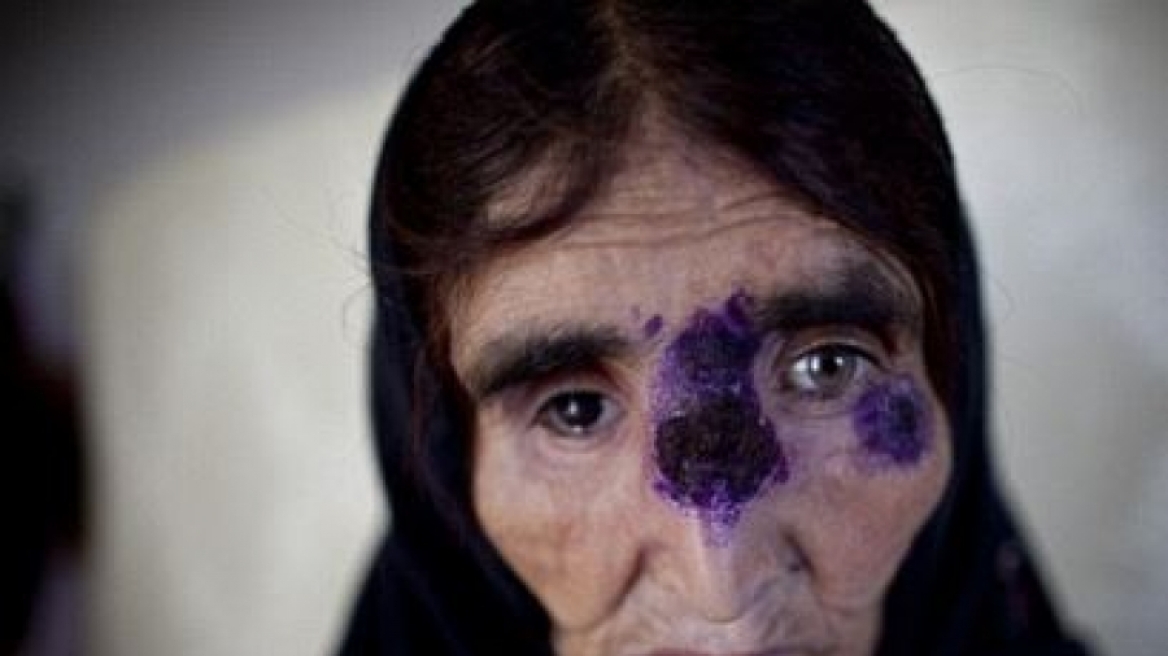 Σαρκοβόρο βακτήριο εξαπλώνεται στην Συρία και το Ιράκ - Τρώει το δέρμα των θυμάτων του