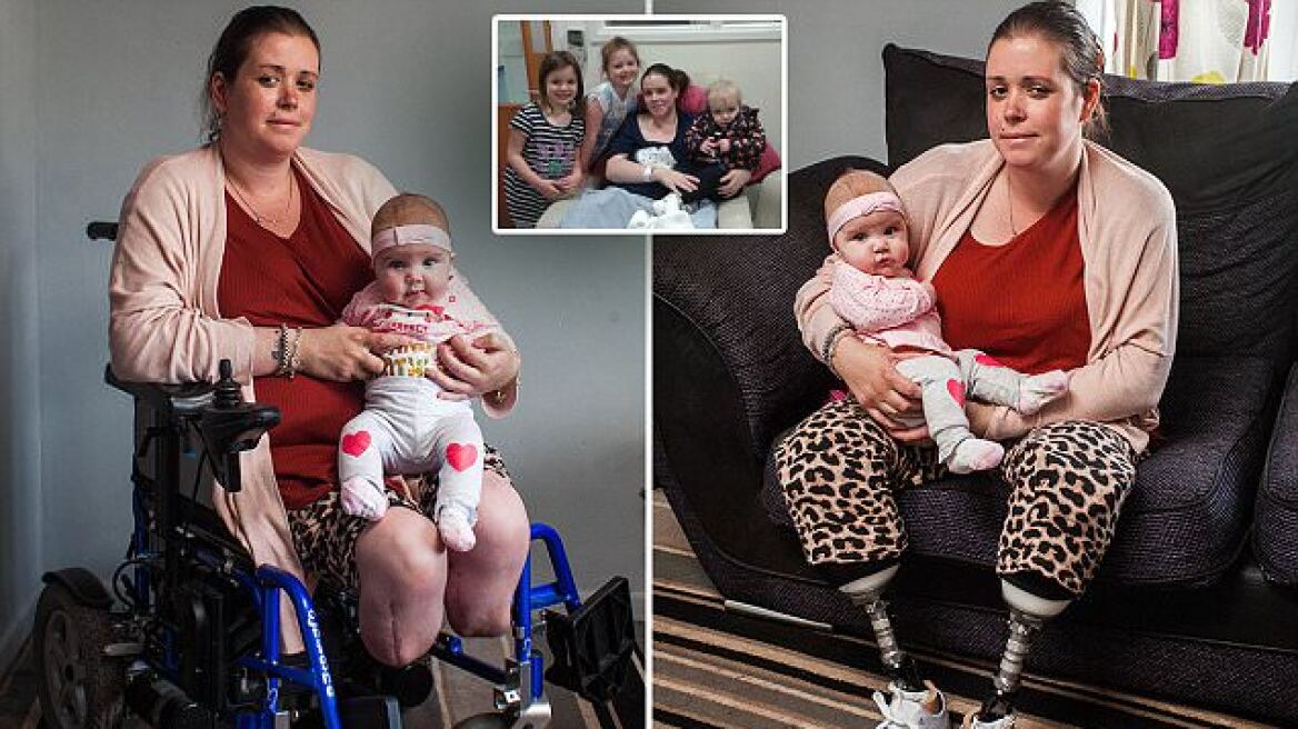 Shocking: Mother wakes up from C-section with no legs (pics)