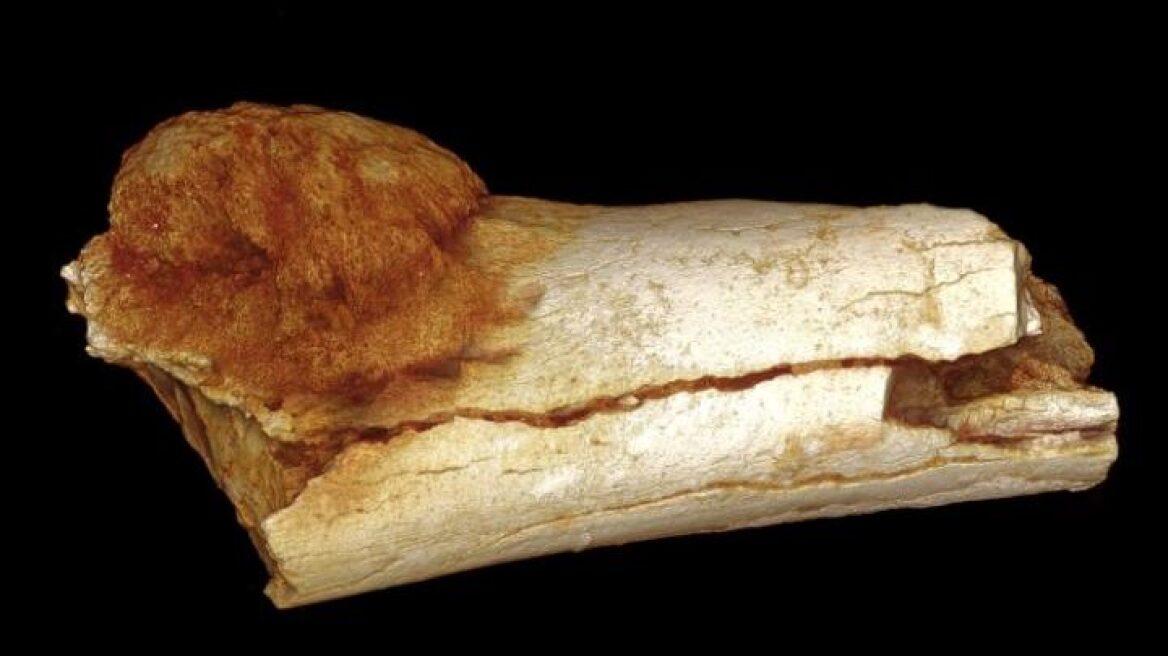 Βρέθηκε το αρχαιότερο δείγμα καρκίνου σε ανθρώπινο οστό ηλικίας 1,7 εκατ. χρόνων
