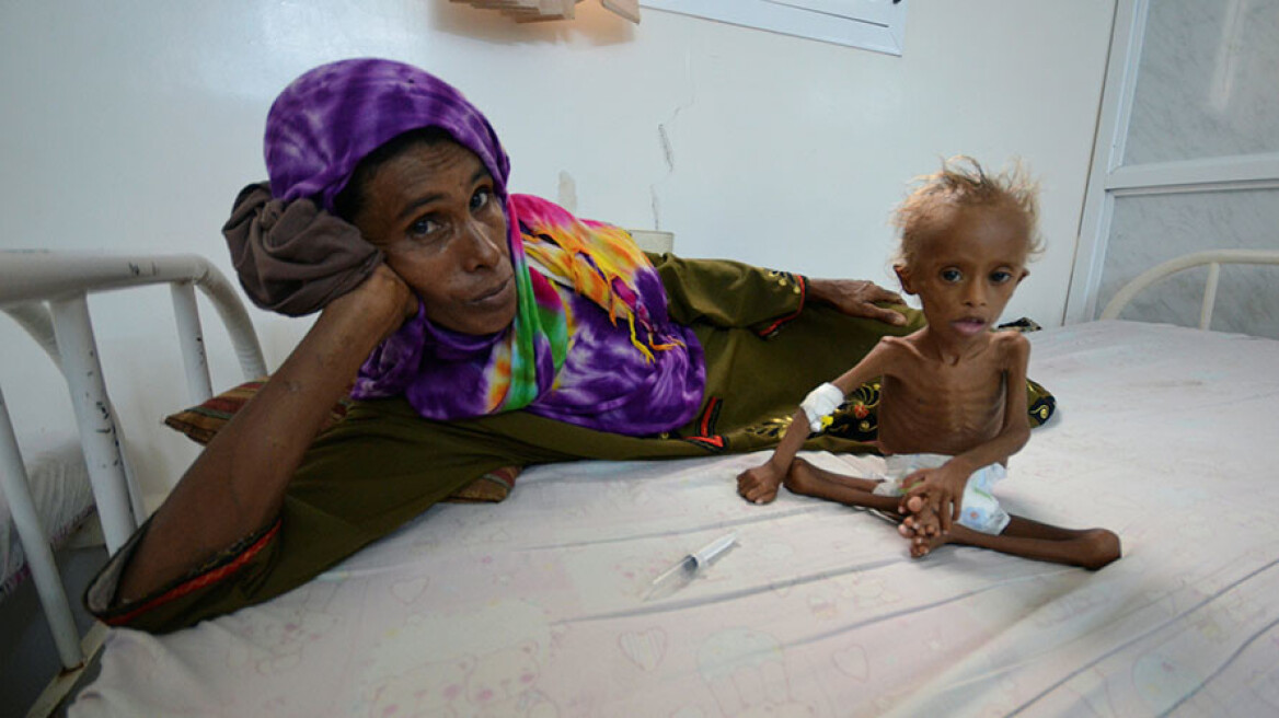 Συγκλονιστική φωτογραφία: Η φρίκη του εμφυλίου της Υεμένης σε ένα υποσιτισμένο παιδί