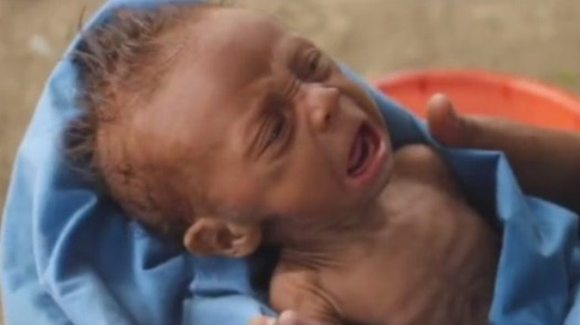 Στη Βενεζουέλα του Μαδούρο τα παιδιά «σβήνουν» από υποσιτισμό...