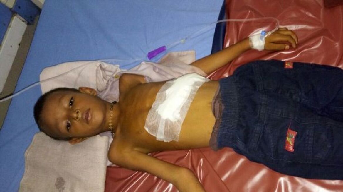 Ινδία: 6χρονος «κυοφορούσε» το δίδυμο αδερφό του